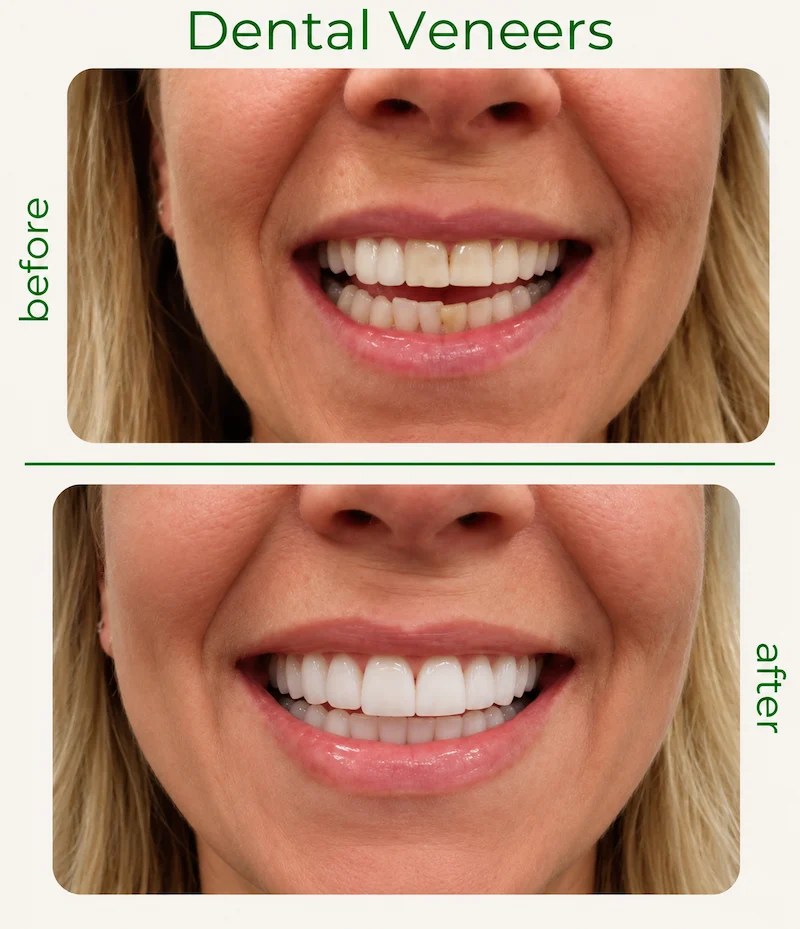 Before and after dental veneers showing an improved, more even smile in Morton Grove, Illinois.