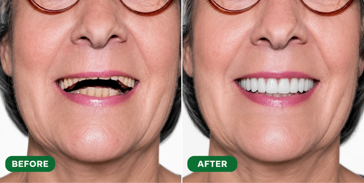 Before and after dentures showing improved smile and natural-looking teeth at ProCare Family Dental in Morton Grove