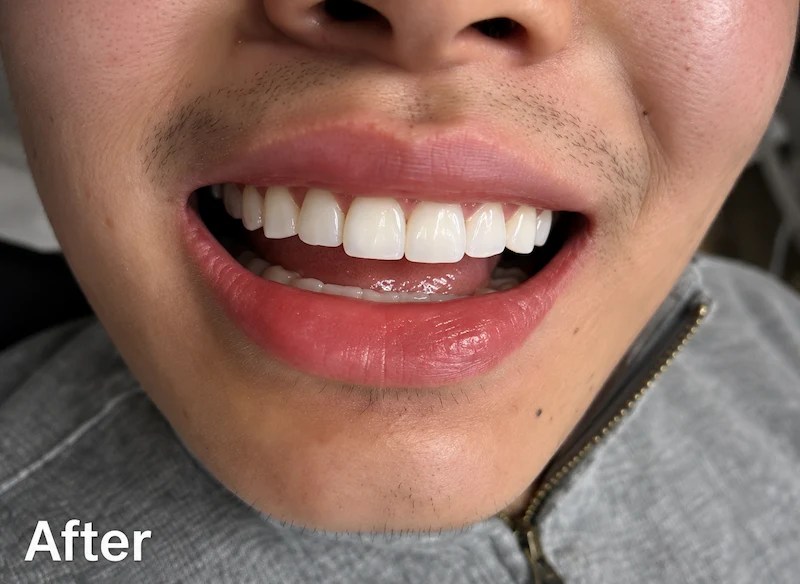 After enameloplasty showing smoother, more even front tooth edges in a ProCare Family Dental patient in Morton Grove, Illinois.