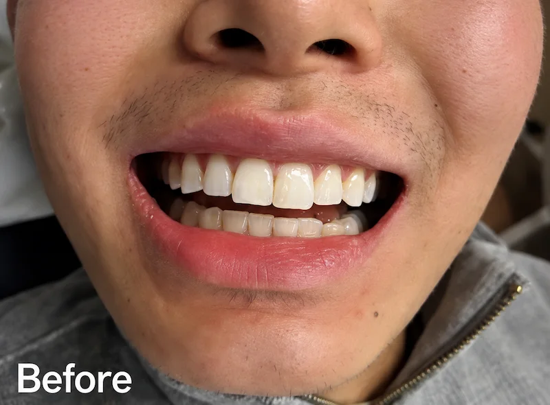 Before enameloplasty showing uneven front tooth edges in a ProCare Family Dental patient in Morton Grove, Illinois.